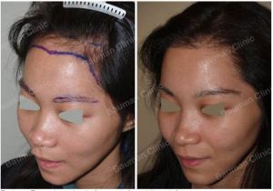 Cấy lông mày và cấy tóc nữ Bauman Clinic - ca 8