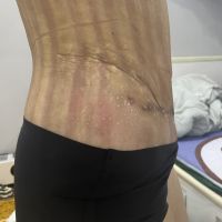 Tạo hình thành bụng xong bị nhăn nhúm