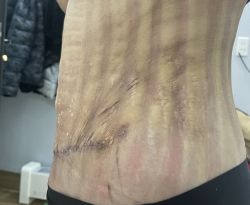 Tạo hình thành bụng xong bị nhăn nhúm