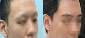 Cấy lông mày tự thân, khách hàng nam - ca 10