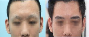 Cấy lông mày tự thân, khách hàng nam - ca 10