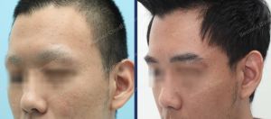 Cấy lông mày tự thân, khách hàng nam - ca 10