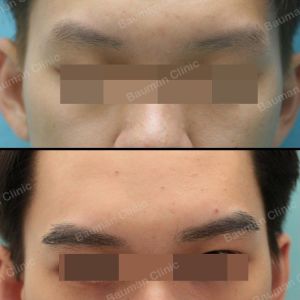 Cấy lông mày nam Bauman Clinic - ca 11