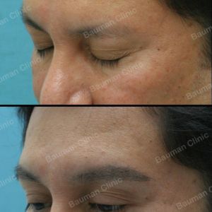 Cấy lông mày khách hàng nam - ca 12