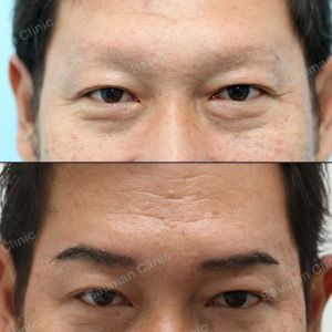 Cấy lông mày nam giới - ca 9