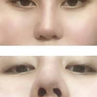 Mũi bị nghiêng bẩm sinh, sau 2 tuần nâng thấy nghiêng rõ hơn phải giải quyết như thế nào Mũi bị nghiêng bẩm sinh, sau 2 tuần nâng thấy nghiêng rõ hơn phải giải quyết như thế nào