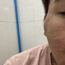 Nổi cục u sau 10 ngày căn chỉ