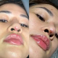 Mụn bọc xuất hiện dưới đầu mũi, khiến mũi bị kéo dài xuống