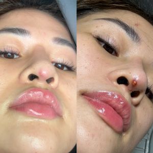 Mụn bọc xuất hiện dưới đầu mũi, khiến mũi bị kéo dài xuống