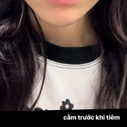 Tiêm tan filler cằm