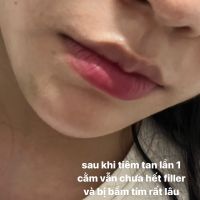 Tiêm tan filler cằm