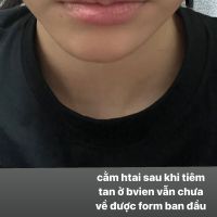 Tiêm tan filler cằm