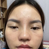 Chào bác sĩ,em nâng mũi bán cấu trúc đã được 22 ngày mà vẫn còn đau,em nên làm gì ạ
Mũi sau nâng được 10 ngày thì em thấy bình thường và không có cảm giác đau gì cả.nhưng sau ngày thứ 10 em mới thấy đau nhức đến nay cũng được 22 ngày mà vẫn đau nhức,
