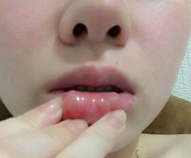 tiêm filler bị sưng