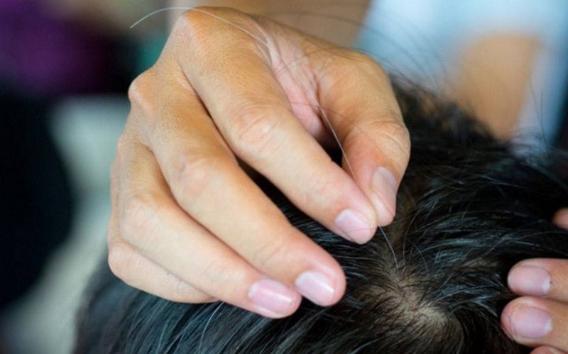 Nguyên nhân có nhiều tóc sâu là gì