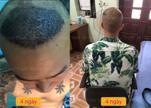 Cấy tóc tự thân đẹp tự nhiên 2850 nang tóc