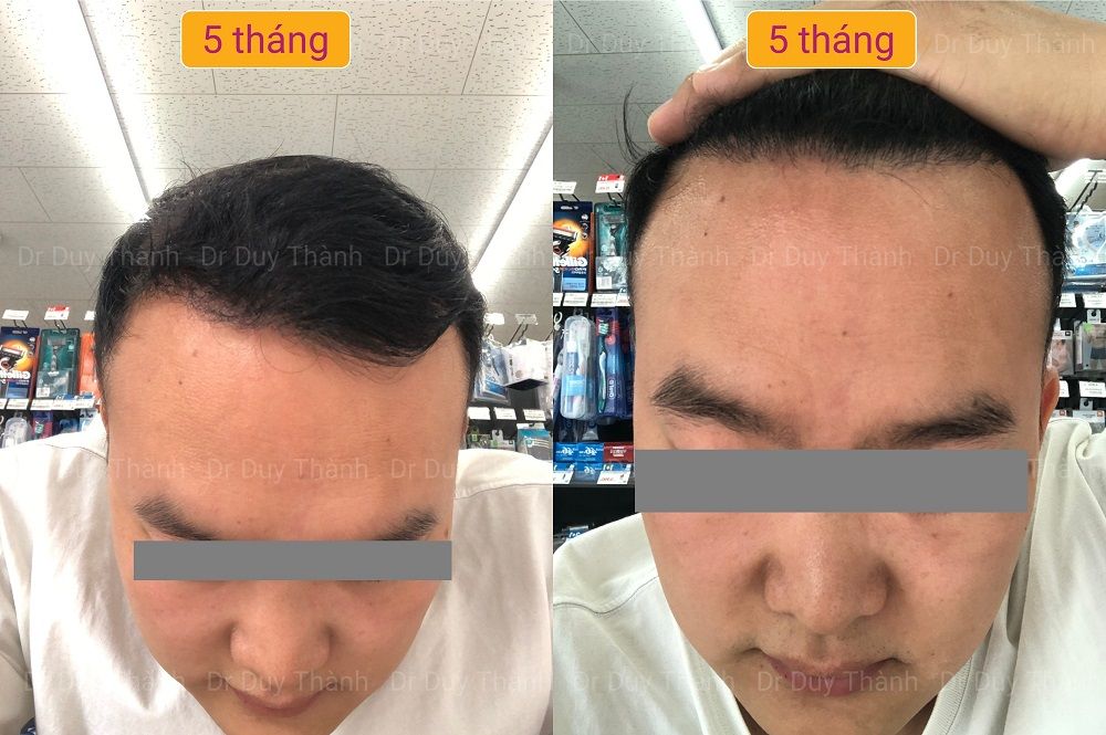 Cấy tóc tự thân đẹp tự nhiên 2850 nang tóc