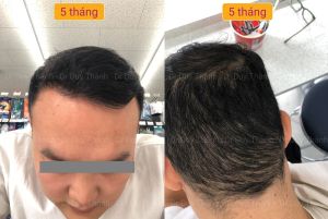 Cấy tóc tự thân đẹp tự nhiên 2850 nang tóc