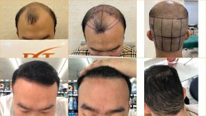 Cấy tóc tự thân đẹp tự nhiên 2850 nang tóc
