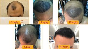 Cấy tóc tự thân đẹp tự nhiên 2850 nang tóc