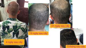 Cấy tóc tự thân đẹp tự nhiên 2850 nang tóc