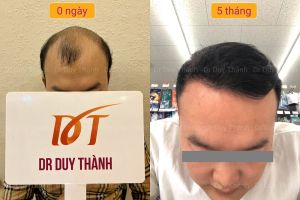 Cấy tóc tự thân đẹp tự nhiên 2850 nang tóc