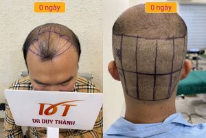 Cấy tóc tự thân đẹp tự nhiên 2850 nang tóc