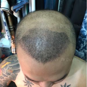 Cấy tóc tự thân đẹp tự nhiên 2850 nang tóc