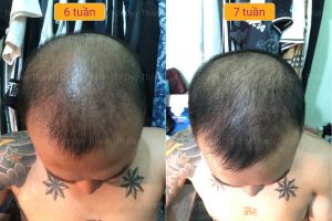 Cấy tóc tự thân đẹp tự nhiên 2850 nang tóc