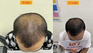 Cấy tóc tự thân đẹp tự nhiên 2850 nang tóc