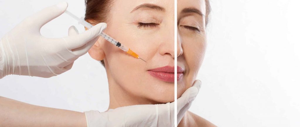 tiêm filler bi sung