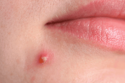 Nguyên Nhân Gây Mụn Trứng Cá