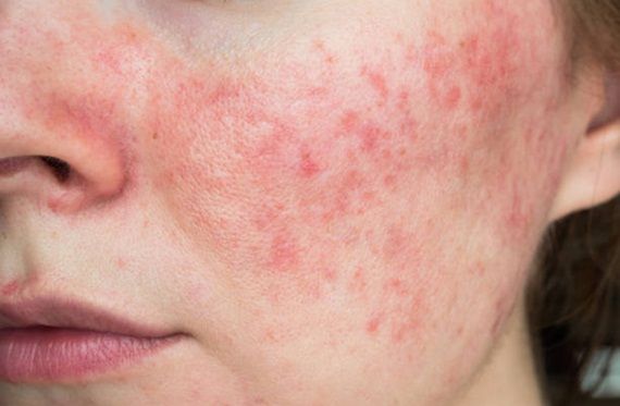 Chăm Sóc Da Bị Bệnh Trứng Cá Đỏ