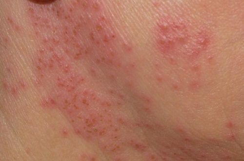 benh viem da tiep xuc