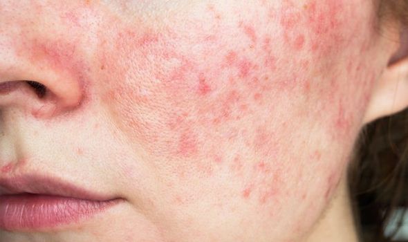Thế Nào Là Da Châm Chích? Khắc Phục Bằng Cách Nào?