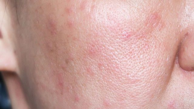 Hiểu Về Da Nhạy Cảm