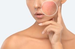 Tại Sao Da Nổi Mụn, Mẩn Đỏ, Châm Chích Khi Dùng Một Sản Phẩm Chăm Sóc Da Mới?