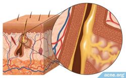 Làm Thế Nào Để Giảm Tiết Bã Nhờn Từ Bên Trong?