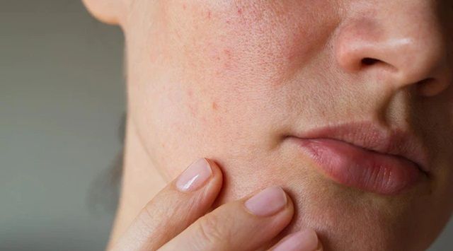 Thế Nào Là Da Quá Nhạy Cảm?