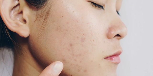 Điều Trị Tăng Sắc Tố Sau Viêm Bằng Cách Nào?