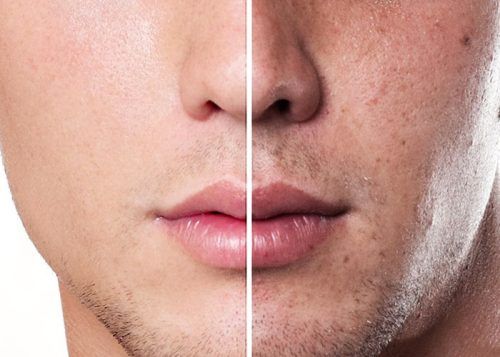 Da Mặt Sạm Đen Ở Nam Giới