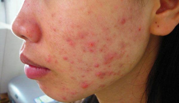 dieu tri mun trung ca do