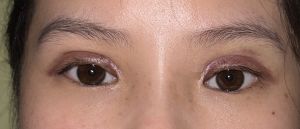 bao lâu thì mắt hết thâm tím