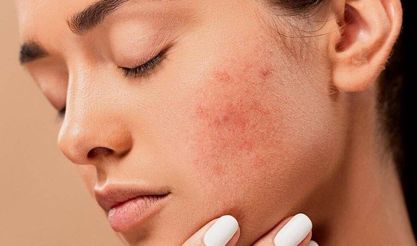 khac phuc da bi cham chic