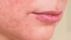 Mẩn Đỏ, Viêm Da Và Các Tác Dụng Phụ Khác Của Retinoid