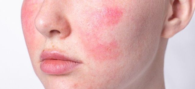 Cách Điều Trị Bệnh Trứng Cá Đỏ (Rosacea) Từ Bên Trong