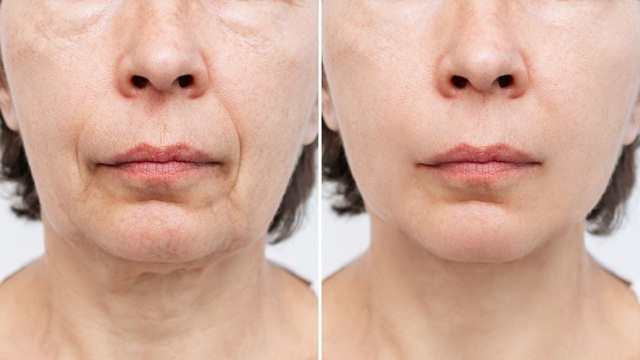 Các cách làm săn chắc da lỏng lẻo, chảy xệ