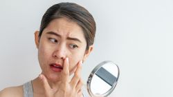 Mụn ẩn điều trị bằng cách nào?