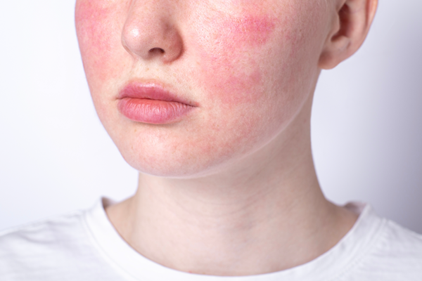Bị bệnh trứng cá đỏ nên chọn loại kem dưỡng da và serum nào?