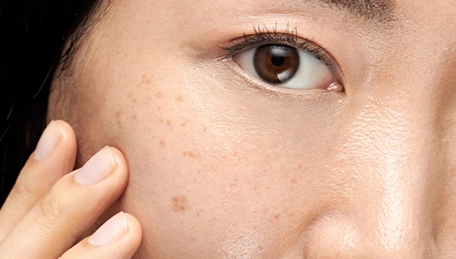 Các phương pháp trị thâm được bác sĩ da liễu khuyên dùng